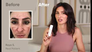 How To Get Rid Of Melasma (With Musely!)