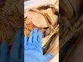 Let's Look Behind a Real Human Liver