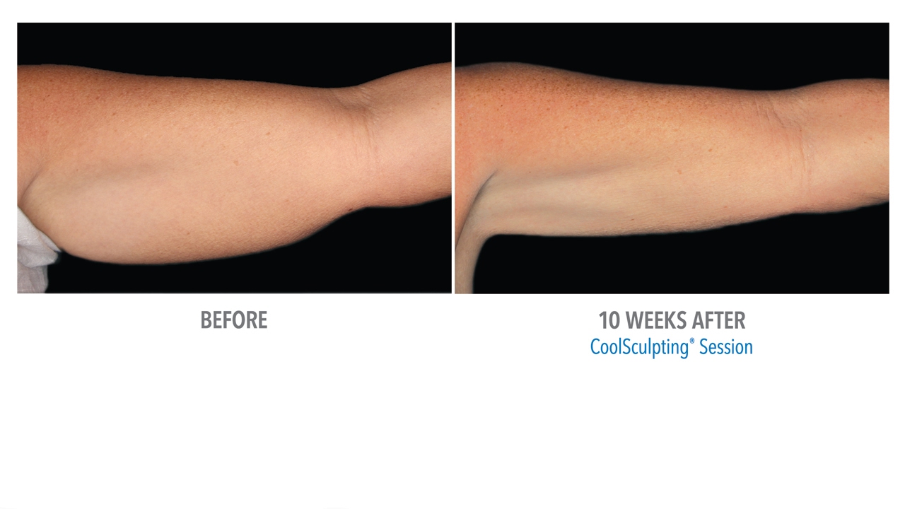 Cool Body Sculpting Cost Beverly Hills LA Call 8187605204 YouTube