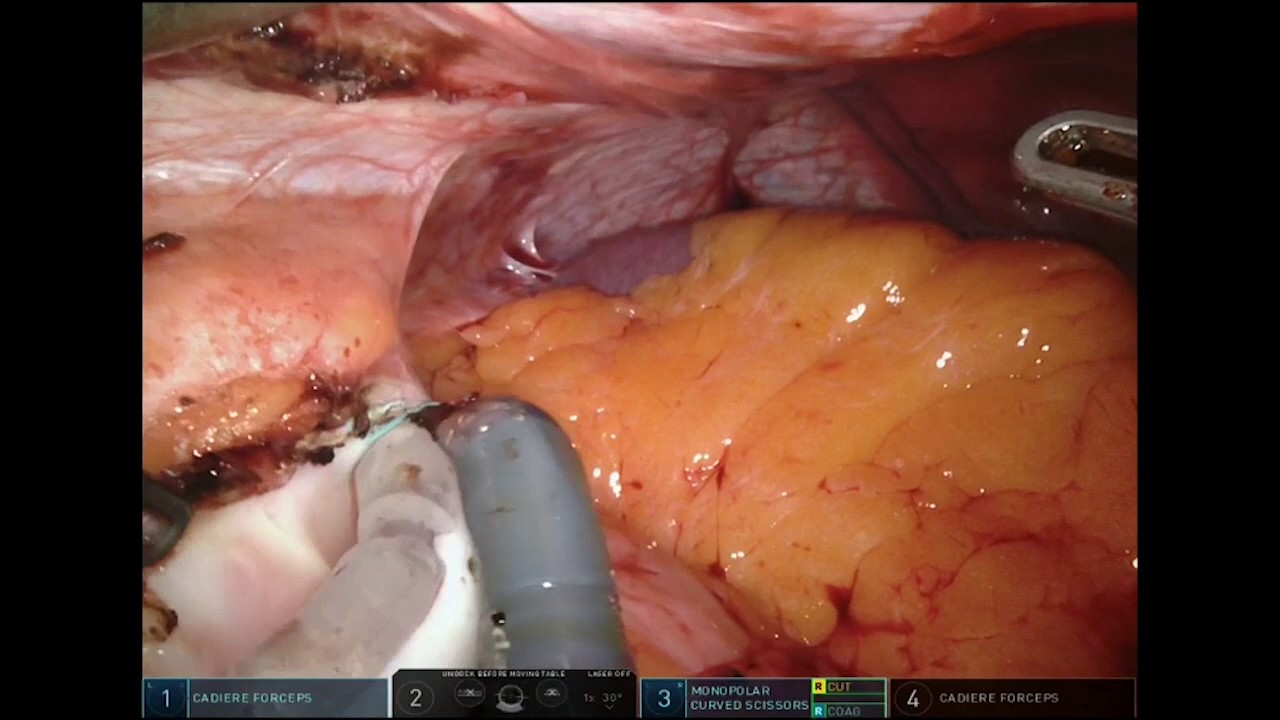 da Vinci Xi Robotic Lap Band Removal - YouTube