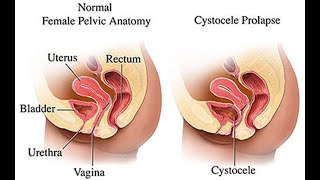 Plastic repair of urethrocele CPT code - simplify medical coding