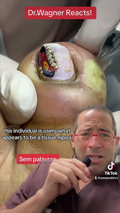 DRAINAGE OF MASSIVE TOE ABSCESS💦#shorts