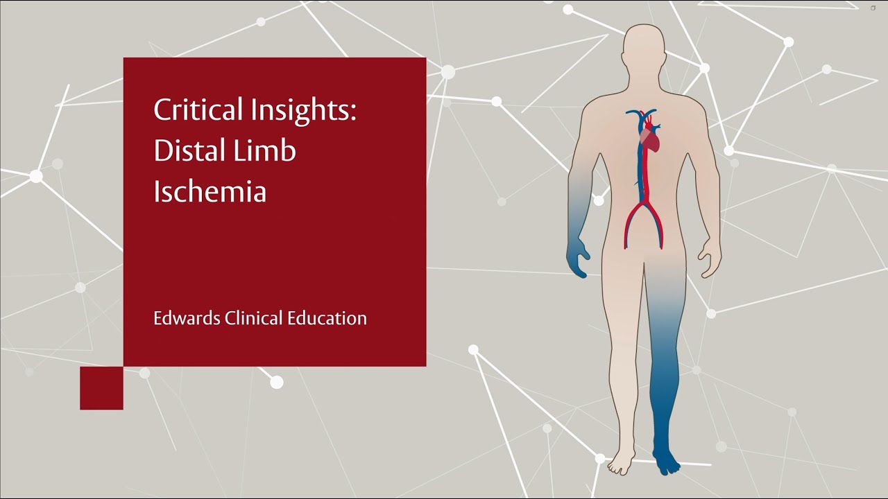 Critical Insights Distal Limb Ischemia YouTube critical-insights-distal-limb-ischemia-youtube