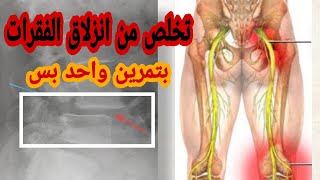 اسباب وأعراض وعلاج ودرجات تزحزح الفقرات واهم تمارين العلاج الطبيعى لعلاج انزلاق الفقرات بدون جراحه