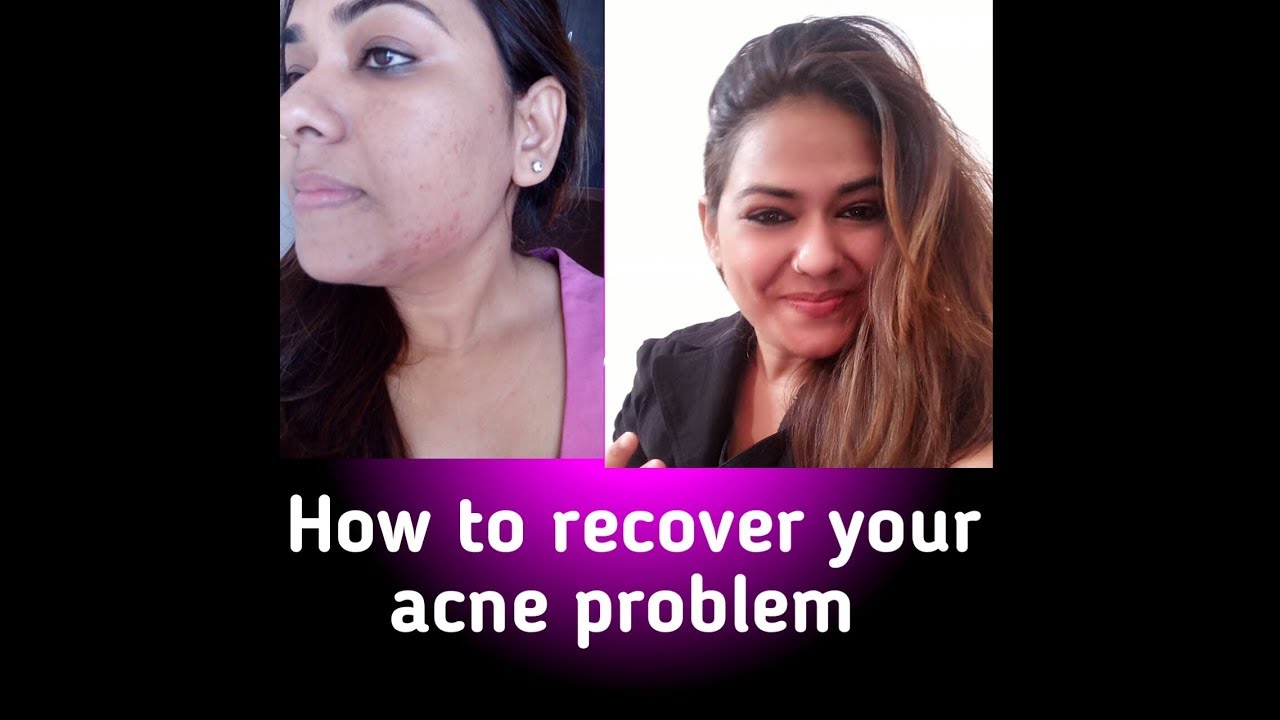 How to recover your acne problem - YouTube