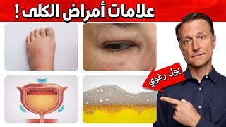 سُمّية الكُلى | عشر علامات تخبرك بوجود مرض في الكُلية وأفضل طعام يساعد في الوقاية من هذه الأمراض