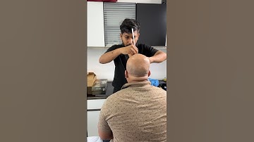 Best scalp micropigmentation in India 8891426652 8078800335 #scalpmicropigmentation #smptraining