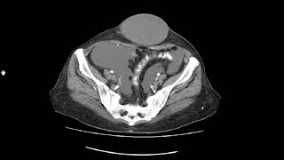 CASE 1040 CT ABDOMINAL WALL CYST AWC