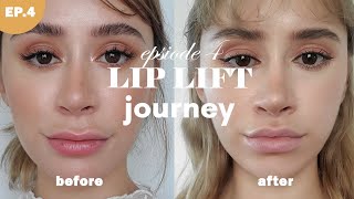 LIP LIFT SURGERY ? Episode 4 - Do I regret it My final results 1.2 years post op