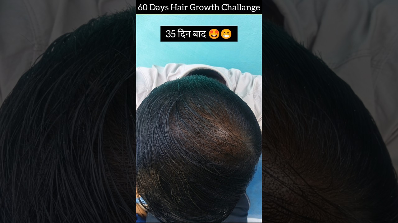 ऐसे किया मैने अपना Hair Regrowth l😍l Jamalgota hair growth treatment l 
