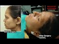 Rhinoplasty surgery in india chennai delhi kolkata bangalore chandigarh coimbatore tambaram nepal