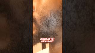 Stop Ignoring Patchy Beard Growth [Black Men 40+]