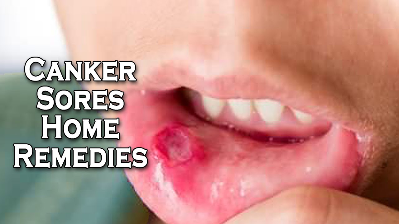 Canker Sore Treatment Home Remedies by Sachin Goyal