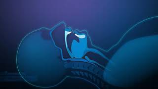 Wirkungsweise Einer Protrusionsschiene Ukps Anti Schnarchschiene