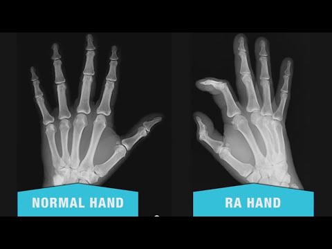 Rheumatoid Arthritis | Myths & Facts of RA | Third Age