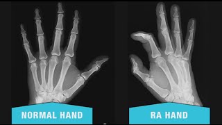 rheumatoid arthritis az orrán