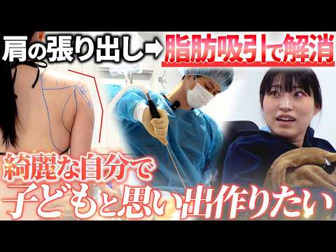 【モニター密着】直角でスラッとした肩になりたいです。二の腕の脂肪吸引で肩の張り出しを解消！患者様のカウンセリングや施術シーン、術後1ヶ月後の拘縮やダウンタイムについても全て公開！
