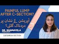 Scar Endometrioma After C-Section? Painful Symptoms &amp; Surgery Explained!