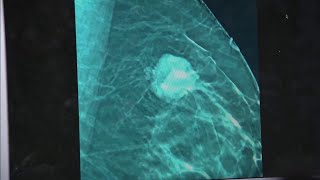 Experts urge women not to delay mammogram screenings