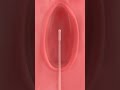 Boosting Pregnancy Odds: The IUI Process Explained ✨