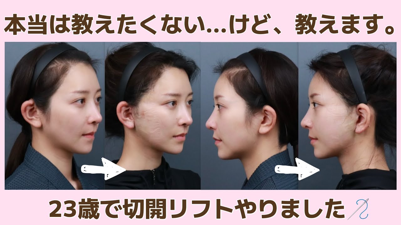 【整形密着】切開リフトしたクリニックが当たり過ぎて神💖