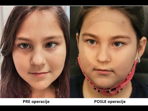 Operacija strabizma kod dece - iskustvo pacijentkinje, specijalna bolnica Sveti Vid