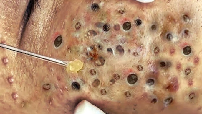 Blackhead Removal With Sac Dep Spa @11087