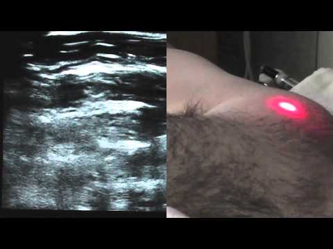 ultrasound guided pecs block ssrausa com youtube pec block
