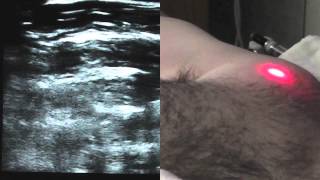 Ultrasound Guided PECS Block - SSRAUSA.com