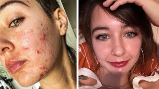 HOW SHE GOT RID OF HER CYSTIC ACNE & SCARS SO FAST!