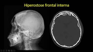 Hiperostose frontal interna