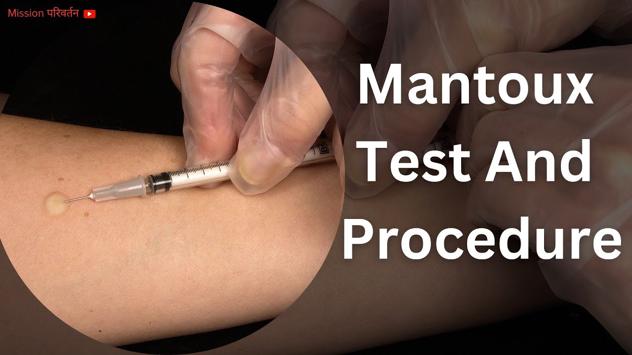 mantoux-test-procedure-positive-results-negative-results-youtube