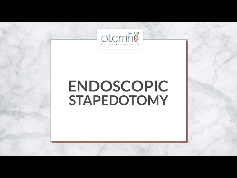 ENDOSCOPIC Stapedotomy - Dr. Luciano Moreira - Estapedotomia endoscópica da orelha direita