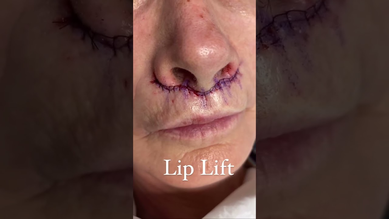 lip lift washington d.c. Lip Lift in Washington, D.C