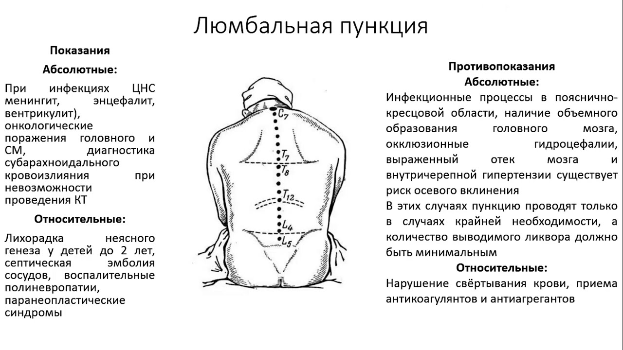 Люмбальная пункция алгоритм