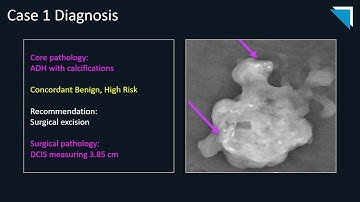 Radiologic-Pathologic Correlation in Breast Imaging, Part. 1 | 15 Minute Radiology CME