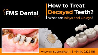 How to Treat Decayed Teeth? What are Inlays and Onlays?  by FMS Dental