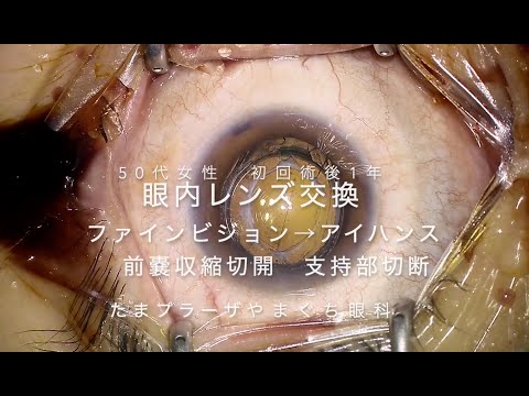 眼内レンズ交換】初回術後1年 ファインビジョン→アイハンス 前嚢収縮