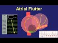 Atrial flutter  fundamentals of diagnosis and ablation