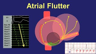 Atrial Flutter  Fundamentals of Diagnosis and Ablation
