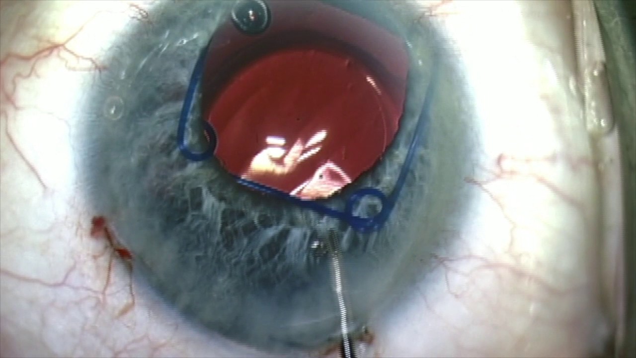 Phacoemulsification With Lysis of Synechiae and Malyugin Ring Implantation  - Eyetube