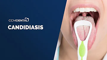 ¿Qué inmunodeficiencia causa la candidiasis oral?