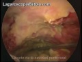 Diverticulitis aguda complicada Hinchey III en paciente obeso mórbido. Hartmann laparoscópica