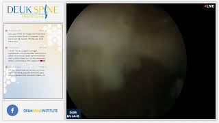 Watch Live Back Treatment! Deuk Laser Disc Repair  Lumbar  B/L L4S1