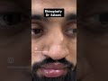 Rhinoplasty surgery in Pakistan by dr Saleem