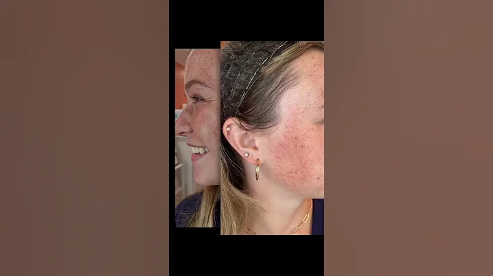 See the INCREDIBLE Results After Just One Lumecca IPL Treatment | #beauty #skincare #shorts