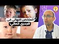 الجدري المائي الاسباب و العلاج هل نستحمى عادي