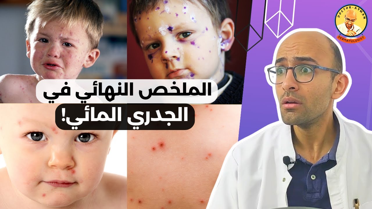 الجدري المائي - الاسباب و العلاج - هل نستحمى عادي ؟