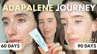 90 Days on Adapalene: The Honest Truth & Results | My Journey Pt.2
