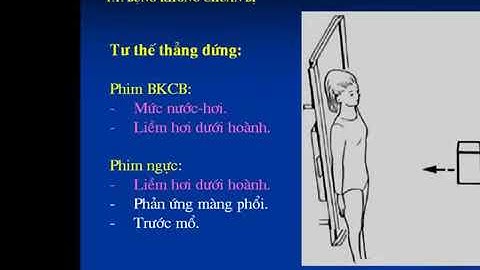 Chẩn đoán hình ảnh cấp cứu bụng   Tắc ruột
